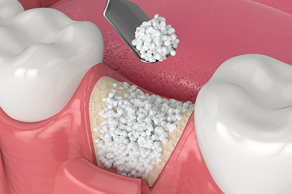JASI Smile | Zirconia Crowns, Implant Dentistry and ClearCorrect reg 