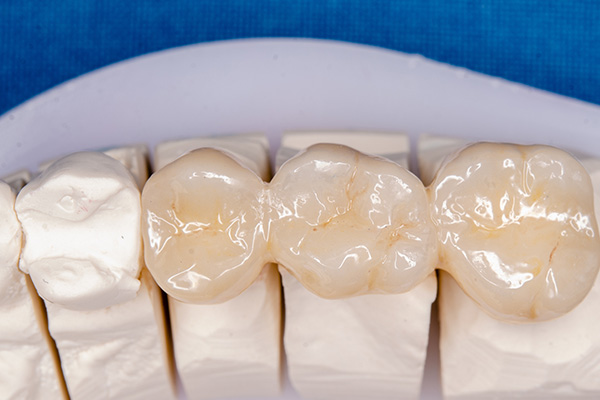 JASI Smile | Veneers, Dental Bridges and Root Canals