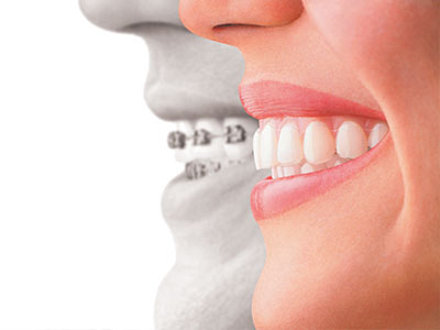 JASI Smile | Veneers, Juvederm reg  and Implant Dentistry