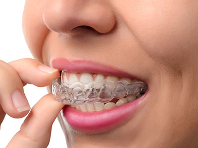 JASI Smile | ClearCorrect reg , Veneers and Zirconia Crowns