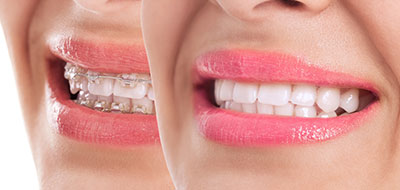 JASI Smile | Juvederm reg , Clear Aligners and Botox reg 