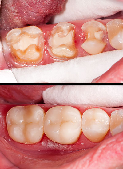 JASI Smile | ClearCorrect reg , Inlays  amp  Onlays and Juvederm reg 
