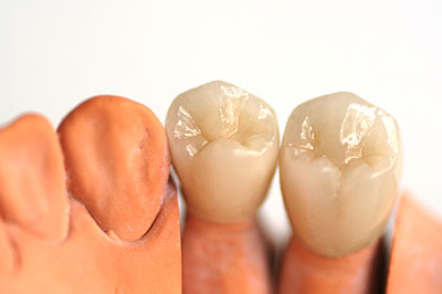 JASI Smile | General Dentistry, ClearCorrect reg  and Zirconia Crowns