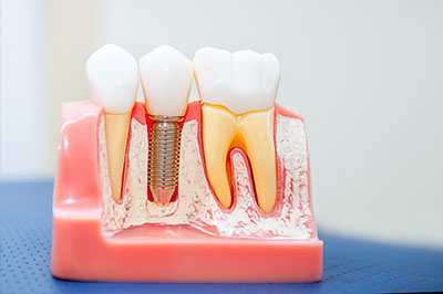 JASI Smile | Invisalign reg , Dental Bridges and General Dentistry