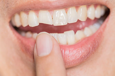 JASI Smile | Botox reg , ClearCorrect reg  and Dental Bridges