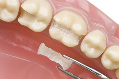 JASI Smile | Root Canals, Dental Bridges and General Dentistry