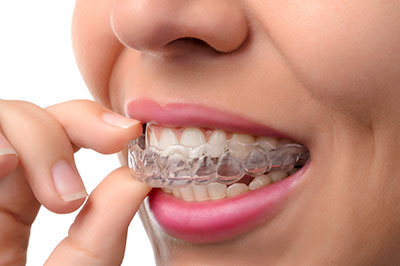 JASI Smile | Implant Dentistry, Root Canals and Inlays  amp  Onlays