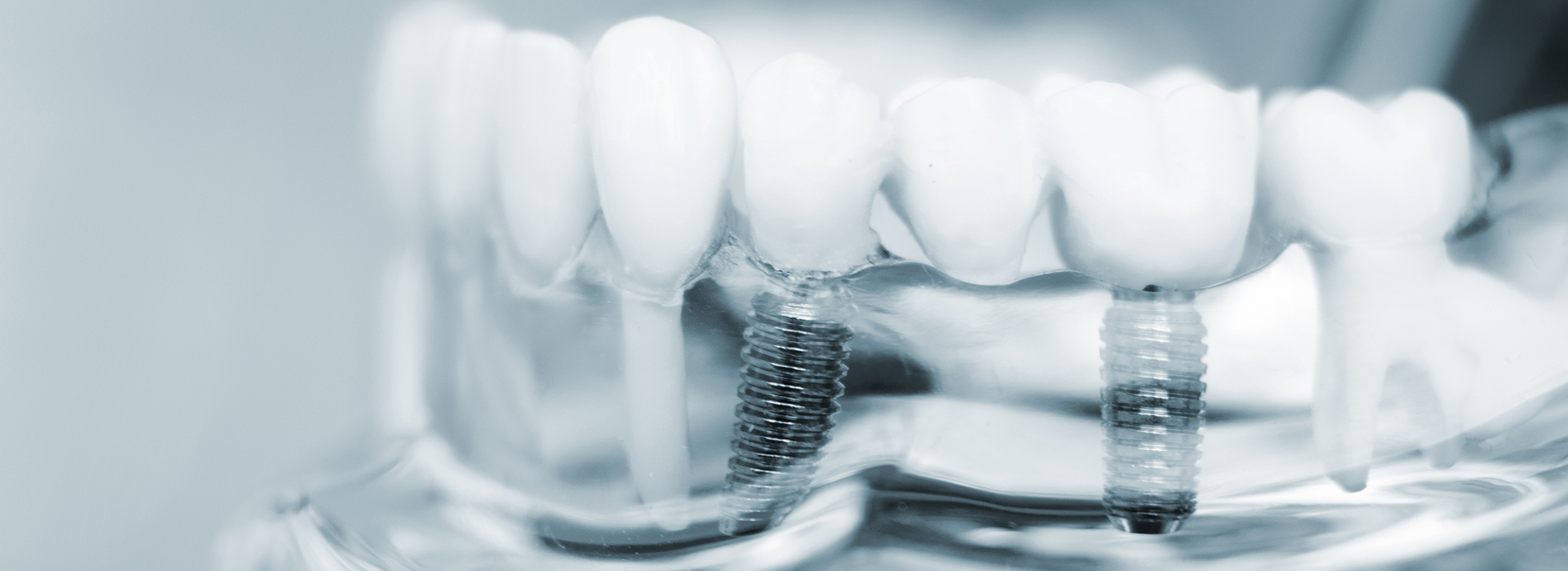 JASI Smile | Dental Bridges, Ceramic Crowns and Inlays  amp  Onlays