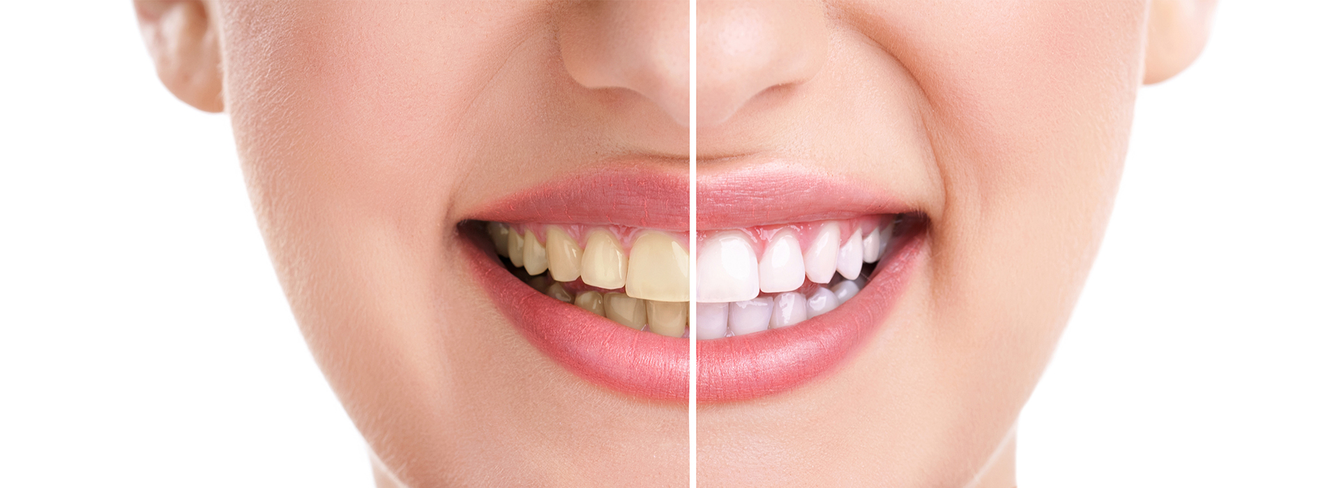 JASI Smile | Root Canals, Cosmetic Dentistry and Veneers