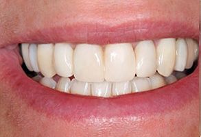 JASI Smile | Ceramic Crowns, Zirconia Crowns and Root Canals