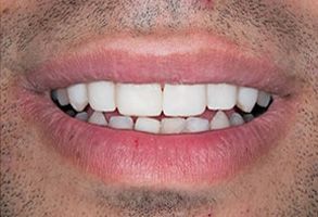 JASI Smile | Invisalign reg , Cosmetic Dentistry and Root Canals
