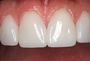 JASI Smile | Root Canals, Clear Aligners and Cosmetic Dentistry