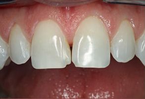JASI Smile | Zirconia Crowns, Veneers and Clear Aligners